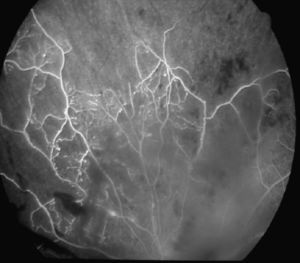 Vasculitis retiniana, áreas de isquemia y hemovítreo.