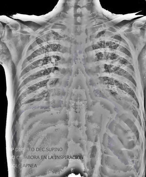Radiografía de tórax: patrón intersticial retículo-nodular bilateral de forma difusa.