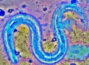 Tinción de azul de metileno (100X) sobre muestra directa de aspirado bronquial, donde se aprecia la estructura interna del parásito Strongyloides stercoralis.