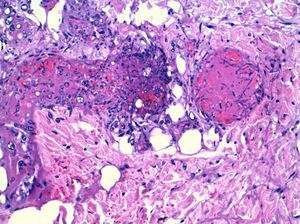 Biopsia cutánea. Tinción de PAS (360×480). Hifas de Aspergillus spp. con invasión vascular y trombosis.