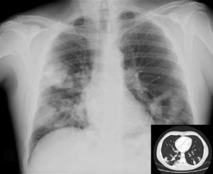 Rx de tórax: infiltrado alveolar parcheado en ambos campos pulmonares, alguno de ellos de morfología nodular. TAC de tórax c/c: opacidades nodulares bilaterales peribroncovasculares y perilinfática sin cavitación con infiltrados alveolares pseudonodulares con broncograma y tendencia a la confluencia en regiones declives de ambos lóbulos inferiores.