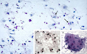 PAAF de pulmón. MO (magnificación original) 640×. Tinción de PAS. Abundantes estructuras de tamaño variable (4-15μm), centro retráctil y coloración rosada, generalmente sueltas y ocasionalmente en el interior de macrófagos (flechas). 1: Tinción de Gomori-Grocott, tinción a base de metenamina de plata. Se observa un halo claro alrededor de los microorganismos. MO 640×. 2: Célula multinucleada gigante con abundantes criptococos en su interior. Tinción de PAS. MO 640×.