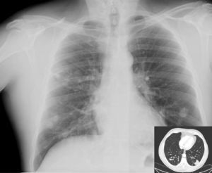 Rx y TAC de tórax c/c a los 12 meses de iniciado el tratamiento antifúngico: opacidades nodulares periféricas, de distribución peribroncovascular de predominio en lóbulos inferiores donde confluyen en lesión nodular de 3,5cm. No presentan cavitación.