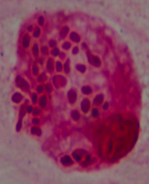 Tinción de Gram de la muestra de LBA, concentrada por citocentrifugación. Se observa la presencia de levaduras intracelulares, en algunos casos con gemación, que presentan un halo de exclusión.