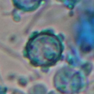 El examen en fresco del hongo filamentoso obtenido tras 15 días de incubación a 25°C muestra la presencia de hifas hialinas septadas, macroconidias esféricas con proyecciones digitiformes y microconidias esféricas pequeñas. Tinción: lactophenol-cotton-blue.