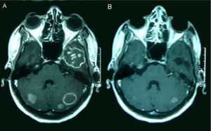 RM (T1 con contraste) en el momento de la presentación del cuadro de aspergilosis cerebral (A) y tras 16 meses de tratamiento antifúngico y antirretroviral (B).
