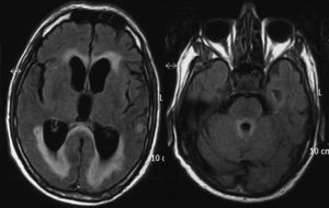 RM cerebral en secuencia FLAIR que muestra hidrocefalia tetraventricular con realce ependimario de cuarto ventrículo y flujo conservado en acueducto de Silvio.