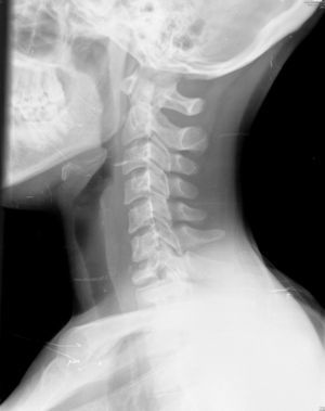 Radiography of the cervical spine showing destruction and collapse of C7 vertebral body.