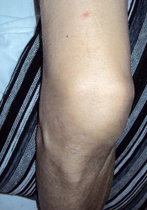 Se observa tumefacción de la rodilla derecha, sin rubor y lesión cutánea en el tercio distal de muslo.