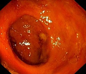 Imagen del colon ascendente. Se puede observar una estenosis tubular severa con engrosamiento de la mucosa, heterogénea, inflamada y edematosa.