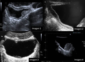 Imágenes de ecografía vesical en pacientes con esquistosomiasis urinaria. Imagen 1: nódulo vesical con engrosamiento vesical difuso. Imagen 2: engrosamiento vesical difuso. Imagen 3: pólipo en cúpula vesical. Imagen 4: gran masa vesical (carcinoma escamoso) con ureterohidronefrosis.