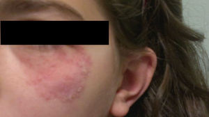 Lesión eritemato-escamosa en la piel de la cara de una niña de 11 años, de un mes de evolución.