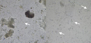 Examen microscópico en fresco, a 400 aumentos, de una misma muestra positiva con quistes de Giardia lamblia mediante la técnica 1 (imagen izquierda) y la técnica 2 (imagen derecha).