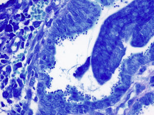 En la histopatología de la biopsia de mucosa antral (tincion de Papanicolau) se observan múltiples estructuras redondeados de aproximadamente 2-3μm en la superficie de las células epiteliales.