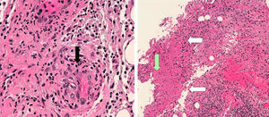 El informe anatomopatológico de la biopsia del ganglio linfático reveló granulomas epitelioides (flechas negras) con centro necrótico (flecha verde) (hematoxilina-eosina, ×10). Los vasos presentaban infiltrados neutrofílicos en la pared (flechas blancas) y alrededor (hematoxilina-eosina, ×40), y la tinción de plata (Wartin-Starry, no se muestra) no fue concluyente.