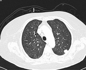 TAC torácica con nódulo pulmonar en el lóbulo superior izquierdo.