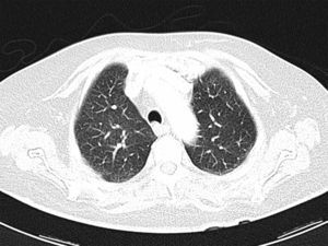 TAC torácica en espiración que muestra la desaparición del nódulo pulmonar.