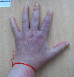 Lesión inicial de la mano izquierda.