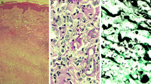 Microscopia óptica de la biopsia cutánea de la lesión de mano. a)Hematoxilina y eosina, 40×. b)Giemsa, 400×. c)Gomori, 400×.