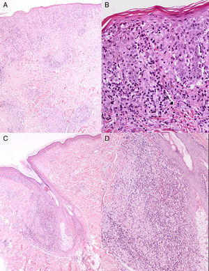 A,B)Infiltrado linfocítico en banda acompañado de histiocitos que borran la unión dermoepidérmica y exocitosis de linfocitos (A: HE, ×40; B: HE, ×200). B,C)Infiltrado polimorfo denso en dermis con refuerzo folicular y focos de granulomas sin necrosis central (C: HE, ×40; D: HE, ×100).