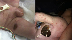Aplasia cutis y herpes zoster neonatal.