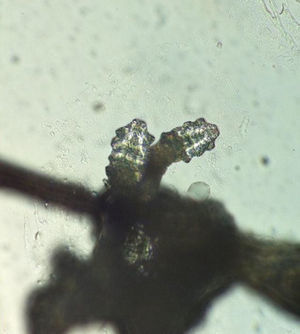 Visualización microscópica de una pareja de ácaros en la base de una pestaña.