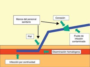 Esquema de las formas de acceso de los microorganismos a los catéteres vasculares.