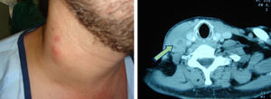 Tromboflebitis séptica de la vena yugular como complicación de una infección relacionada con un catéter venoso central.