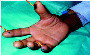 Signos periféricos de endocarditis como complicación de una bacteriemia asociada con un catéter venoso periférico.