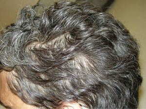 Alopecia apolillada: pequeñas áreas con densidad de cabello reducida, salpicadas en región temporal.