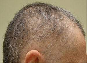 Alopecia difusa «en trasquilones».