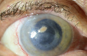 Lesión paracentral hiperplásica y con coloración rosácea.