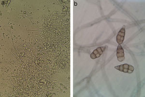 a) Visión directa con KOH (200×). Hifas septadas con presencia de macroconidias incipientes. b) Azul de lactofenol (400×). Macroconidias características del género Alternaria.