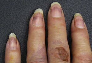 Las ampollas en las manos eran de menor tamaño que en los pies. Las uñas en esta localización presentaban hemorragias en astilla como consecuencia del fenómeno trombótico subyacente.