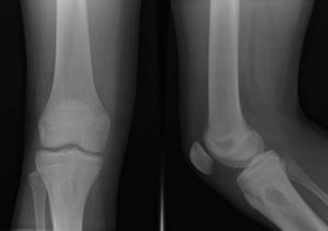 X-ray of the right knee showing a lytic lesion with sclerotic margin.