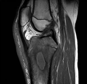 MRI sagittal T1-weighted image showing a 35mm osteolytic lesion with peripheral contrast enhancement affecting both tibial epiphysis and metaphysis.