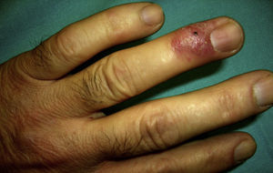Dorso del 4.° dedo de la mano izquierda con una placa eritematosa con pústulas en superficie.