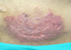 Engrosamiento de la pared abdominal localizado en el cuadrante inferior izquierdo, sugestivo de infección.