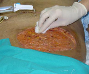 Desbridamiento quirúrgico con resección amplia de la pared abdominal.