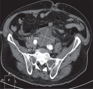 Imagen del TAC con la colección periaórtica desde arteria renal izquierda hasta bifurcación aórtica.
