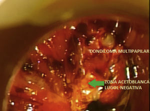 A las 12h, condiloma multipapilar acetoblanco lugol positivo con área lugol negativa en su extremo distal (lesión lugol negativa parcial). Su diagnóstico histológico fue HSIL (AIN-3) con p16 positiva.