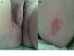 Regional grouped herpetiform vesicles upon the erythematous base affecting right vulvar region (a) and right gluteal region (b).