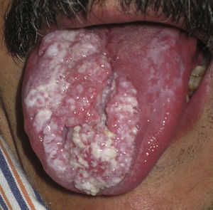 Lesión vegetante blanquecina en la lengua.