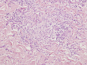 Detalle histológico de un granuloma tuberculoide, en el que se observa una pequeña zona central de necrosis rodeada por una corona inflamatoria compuesta por linfocitos y células gigantes multinucleadas (hematoxilina-eosina, × 200).