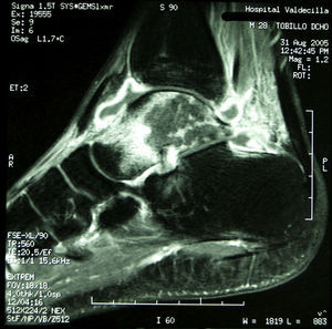 Imagen de RM del tobillo derecho que muestra la osteomielitis del astrágalo.