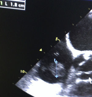 Transesophageal echocardiography (TEE) where a mass sized 18mm is observed in the right atrium (RA).