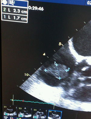 Image of ETE with a 17mm×23mm mass attached to de ICD electrode in RA.