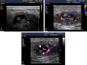 Representative images from a B-scan ultrasound (A, case no. 27) and color and power Doppler sonography (B and C) examination of a parasitic nodules (both from case no. 22). Parasite appears as multiple parallel hyperechoic linear structures (rail track pattern) inside the cysts and blood flow is located in the periphery of the capsule.