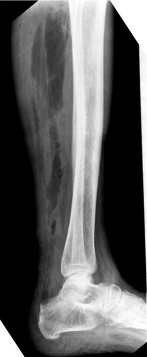 Radiografía simple de tórax de la extremidad afectada.