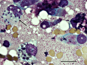 Photomicrography of a Giemsa–Wright stained nasal cytology showing intrahistiocyte Leishmania amastigotes forms indicated by arrow and epithelial cells of the upper respiratory tract on the right. Slides were examined with a Nikon microscope at 1000× magnification. Scale bar indicates 20nm.